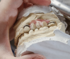 Partial denture made of dental resins