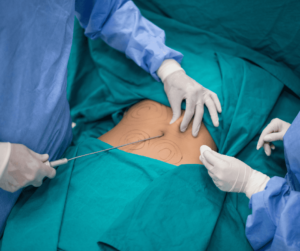 liposuction procedure using liposuction equipment, classification liposuction equipment Colombia