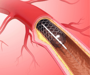 inflation balloon catheter within an artery, classification balloon catheters Costa Rica