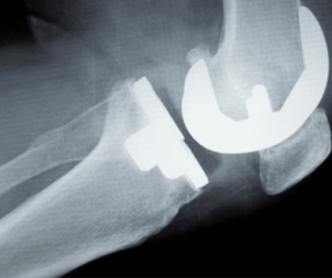 knee orthopedic implant x-ray image, classification orthopedic implants Costa Rica