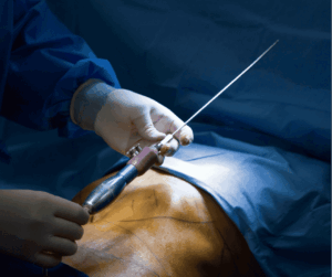 liposuction procedure using liposuction equipment, classification liposuction equipment Costa Rica