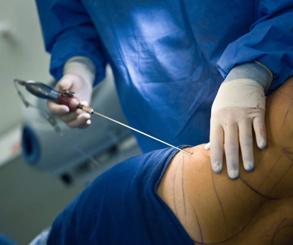 Classification and Grouping of Liposuction Equipment in Mexico