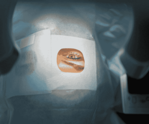 laser eye surgery, ophthalmic laser system classification Mexico